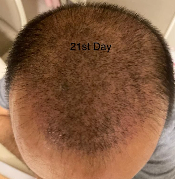 21st Day Hair Transplantation
