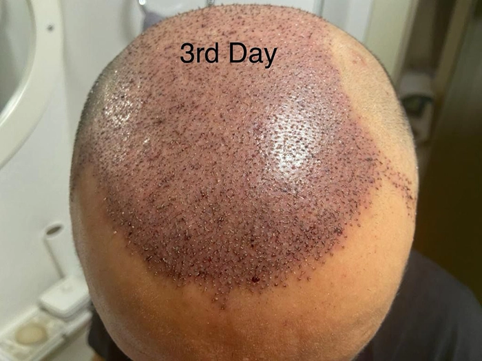 3rd Day Hair Transplantation