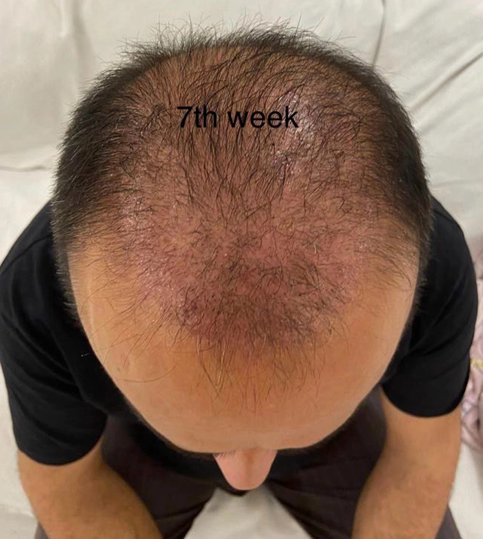 7th Week Hair Transplantation