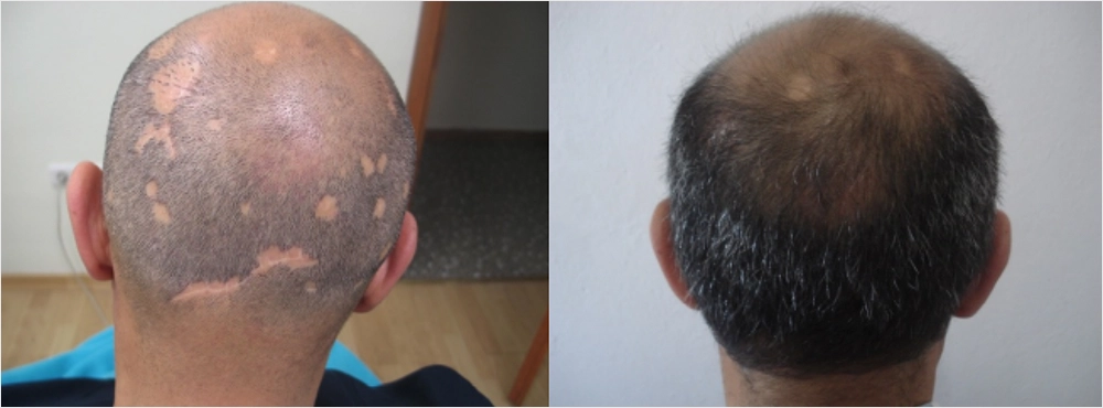 Hair Transplant in Scarring Alopecia