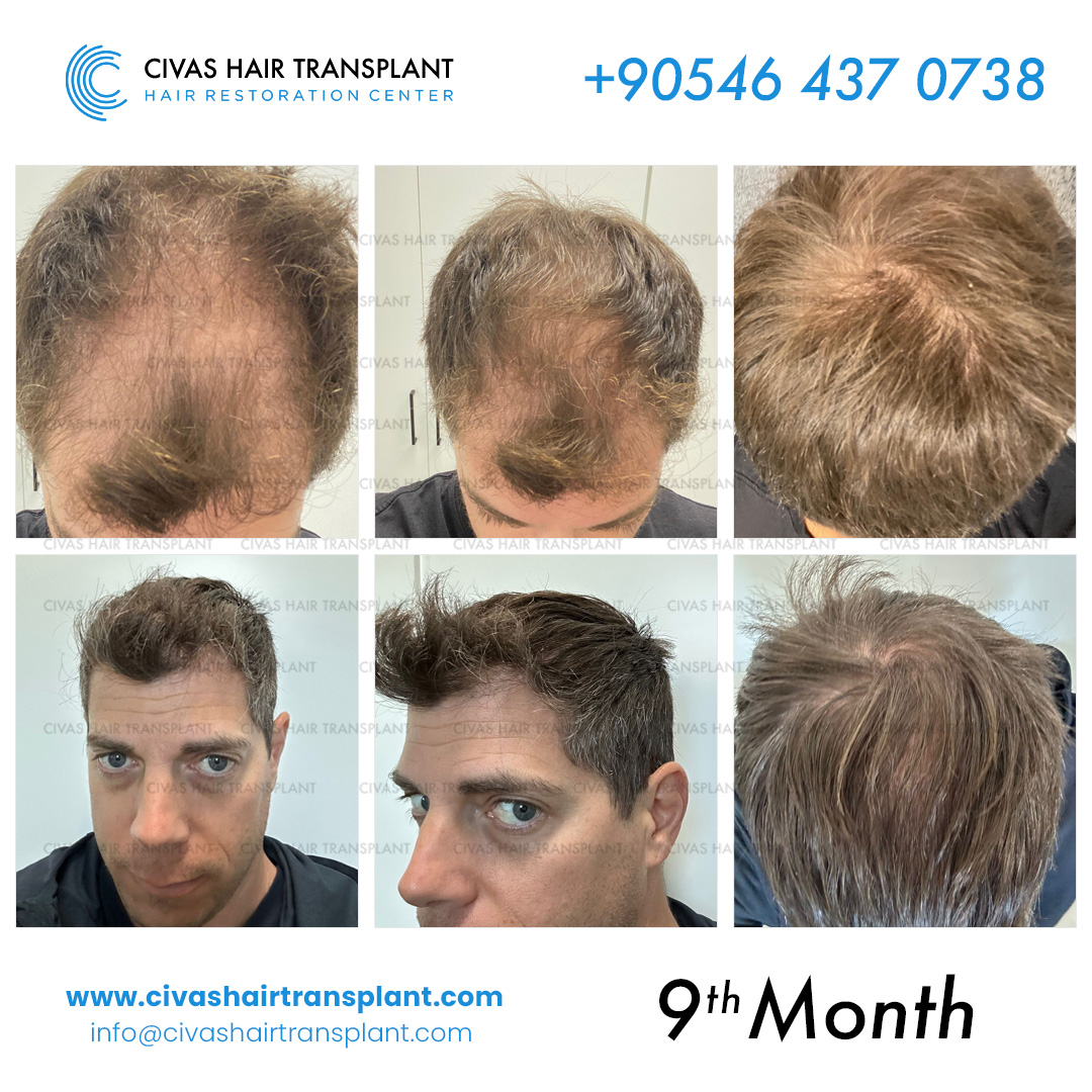 FUE Post-Op Pictures – 6 Months – Hair Transplant Story