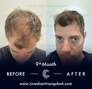 Hair Transplant 2