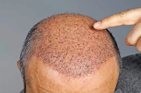 How Can I Protect My Transplanted Hairs?