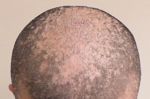 Scarring (Cicatricial) Alopecia