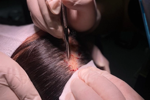 What Are the Limitations of Hair Transplantation?