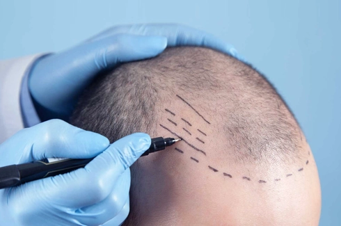 What is the length of a hair transplant surgery?