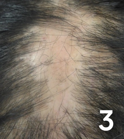 Primary Cicatricial Alopecia