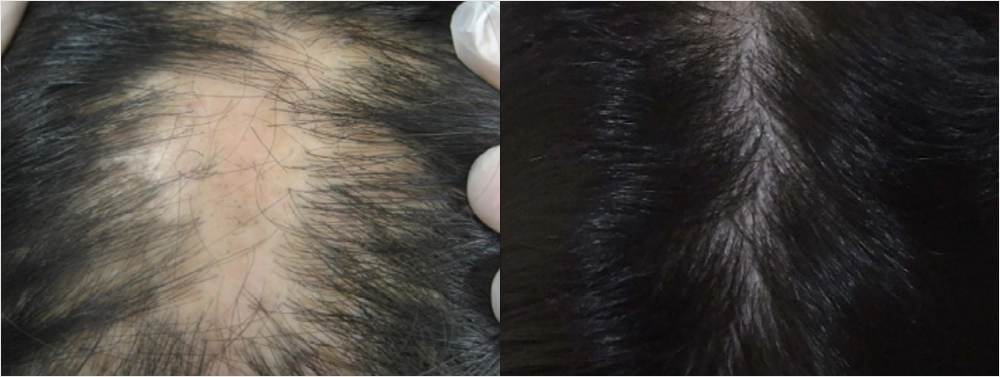 Scarring Alopecia Before After