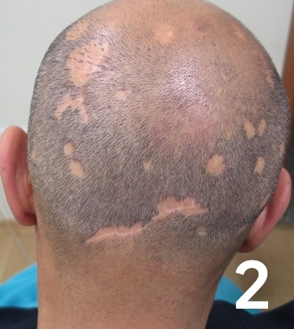 Scarring Alopecia