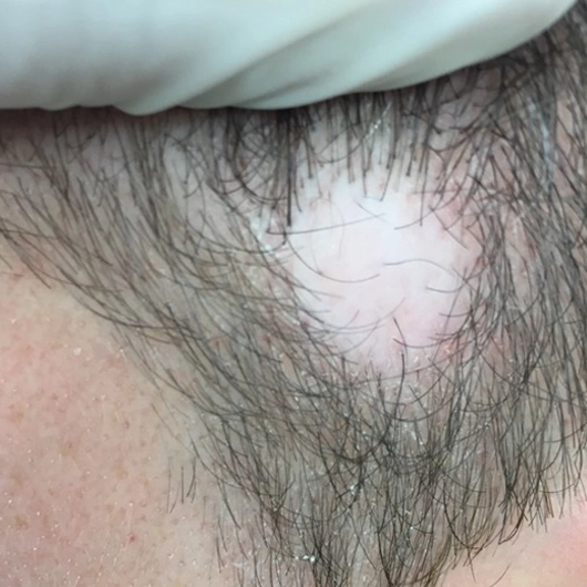 Secondary Cicatricial Alopecia