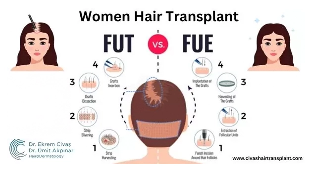 Women Hair Transplant